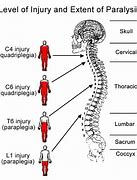 Image result for Stroke Paralysis