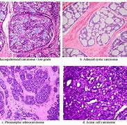Image result for Salivary Gland Tumours