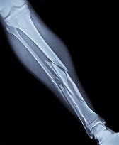 Image result for Broken Leg X-ray Meme