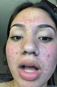 Image result for Bad Acne On Face