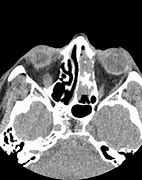 Image result for Inverted Papilloma Radiology/CT