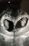 Image result for 14 Week Twin Ultrasound