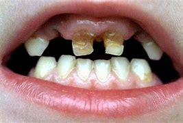 Image result for Rotten Candy Teeth