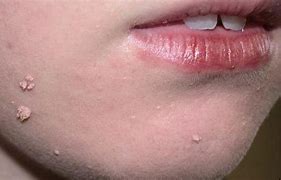 Image result for Warts On Horses Nose