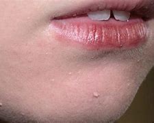Image result for Filiform Warts On Eyelids