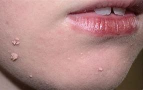 Image result for Wart On Lip