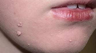 Image result for Filiform Wart Skin