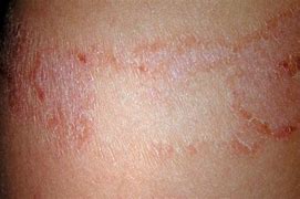 Image result for Soy Allergy Rash