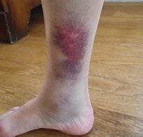 Image result for Bruise On My Thigh