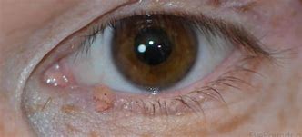 Image result for Papilloma On Upper Eyelid