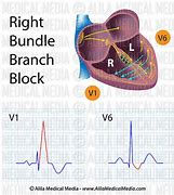 Image result for Bundle Branch Block EKG Examples