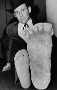 Image result for Person with Big Foot
