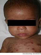 Image result for Congenital Syphilis