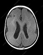 Image result for Lissencephaly Gross Anatomy