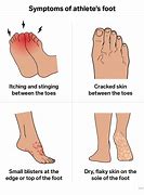 Image result for Different Types of Athlete's Foot