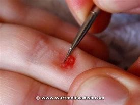Image result for Wart Mole Vanish Scar