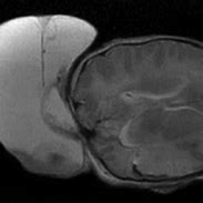 Image result for Encephalocele Brain Tumor
