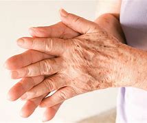 Image result for Age Spots On Hands