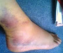 Image result for Rugby Sprained Ankle