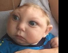 Image result for Kid Born with No Brain
