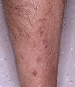 Image result for Diabetic Skin Rash Treatment