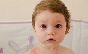 Image result for Full Body Rash Child