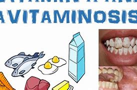 Image result for hipervitaminisis