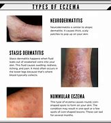 Image result for 7 Types of Eczema