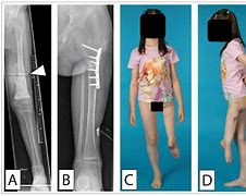 Image result for Sarcoma Bone Cancer