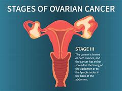 Image result for Ovarian Cancer Tumor