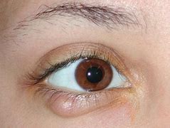 Image result for Wart On Eyelid