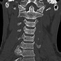 Image result for Cervical Spine Vertebrae