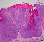 Image result for Molluscum Contagiosum On Black Skin