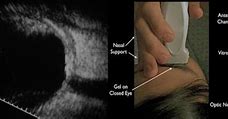 Image result for Ultrasound for Back of Eye