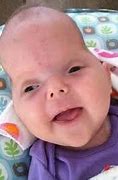 Image result for Syndromic Craniosynostosis