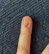 Image result for Periungual Wart