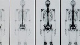 Image result for Abnormal Bone Scan