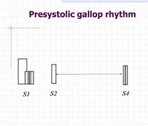 Image result for Gallop Rhythm