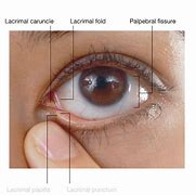 Image result for Gray Line in Eye