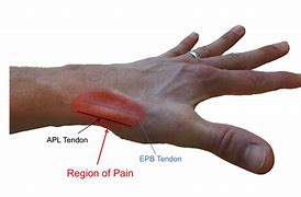 Image result for Wrist Pain On Thumb Side