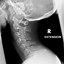 Image result for Congenital Cervical Spine Fusion