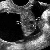 Image result for Peritoneal Inclusion Cyst