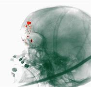 Image result for Headshot Wound