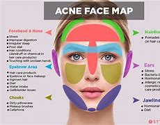 Image result for Acne Location Map