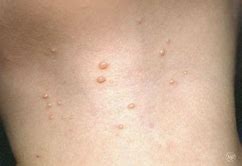 Image result for Eczema Molluscatum