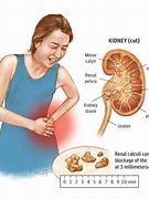 Image result for Red Kidney Stones