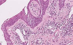 Image result for Conjunctival Papilloma Pathology