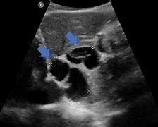 Image result for Anechoic Cyst On Ultrasound