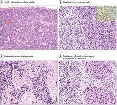 Image result for Small Cell Carcinoma Bladder Cancer