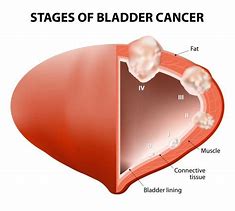 Image result for Bladder Wall Cancer